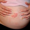 Особенности протекания дерматита при беременности