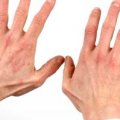 Лечение псориаза на ладонях рук