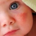 Мази при дерматите у ребенка