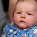 Аллергический дерматит у детей и новорожденных