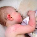 Разновидности дерматитов у детей