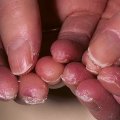 Лечение экземы на пальцах рук