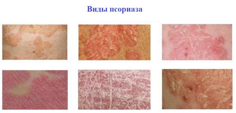 Псориаз можно вылечить в домашних условиях 836