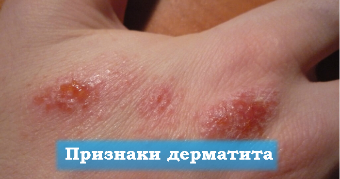 Экзематозный дерматит: симптоматика и его лечение