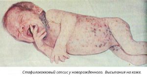 Стафилококковый дерматит