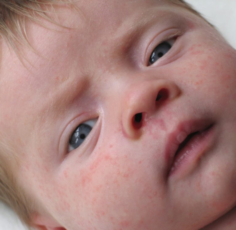 Дерматит у детей: описание симптомов и рекомендации к лечению