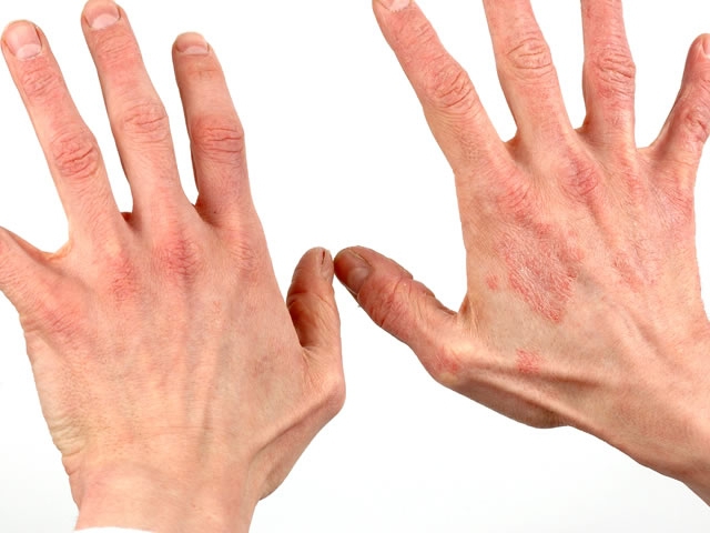 дерматит на руках