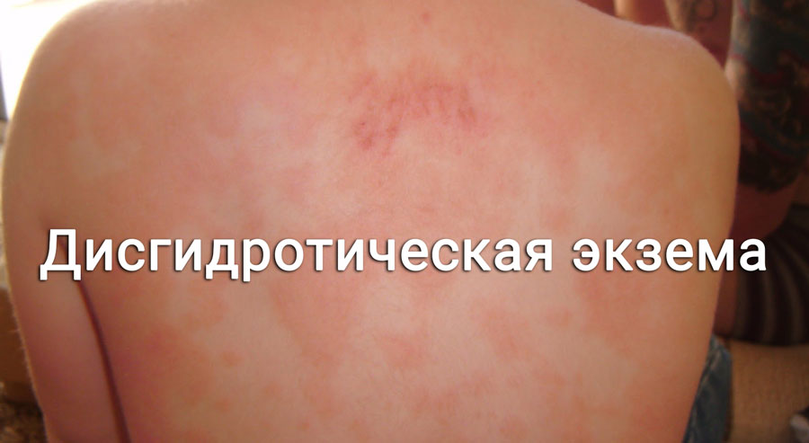 Как и почему проявляется дисгидротический дерматит