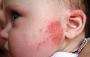 Мокнущий дерматит у ребенка