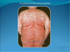 Псориатическая эритродермия