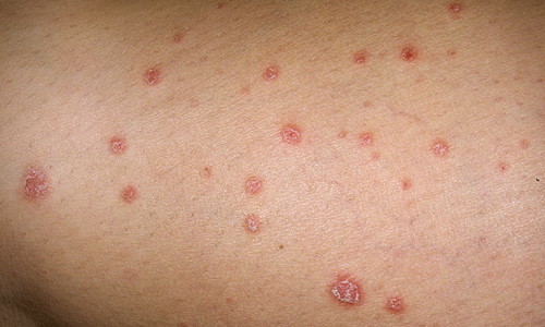 Токсико-аллергический дерматит